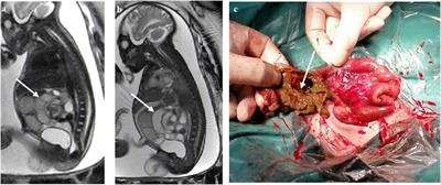 Prenatal diagnosis of midgut volvulus by fetal MRI: a retrospective study